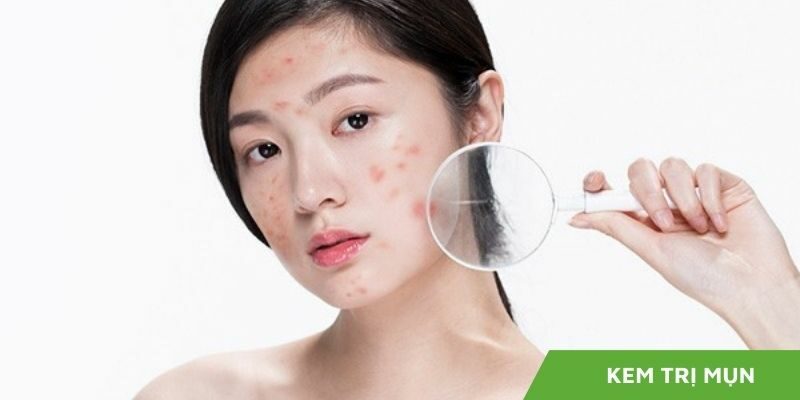 Top 9 Kem Trị Mụn Hiệu Quả Nhất 2025 – Review Chi Tiết Cho Từng Loại Da